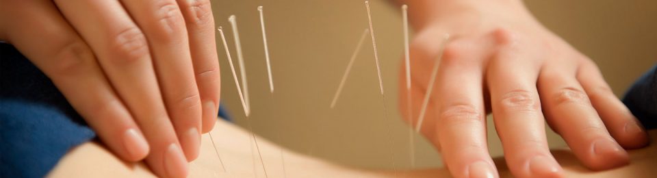 Acupuncture Treatment Brisbane